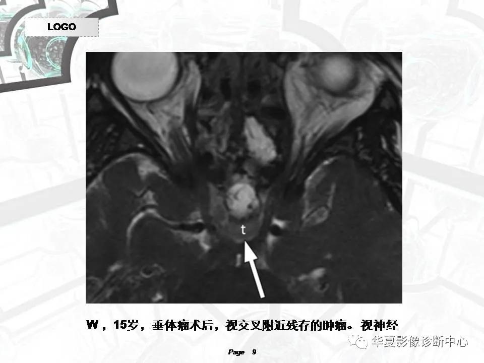 磁共振颅神经扫描是定位在哪,颅神经图谱