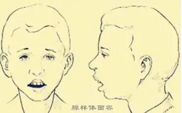 快速根治打鼾专利,打呼噜最新研究成果