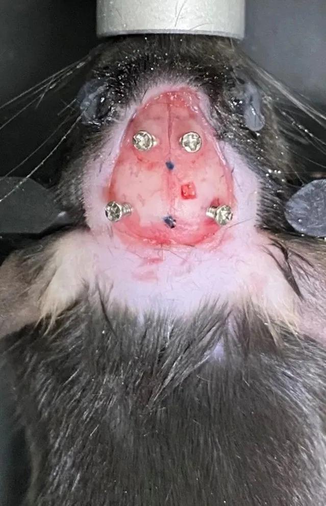 晶体植入手术的分享,可调微丝阵列电极