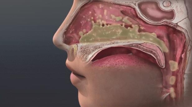 打个喷嚏导致骨折,鼻炎导致车祸