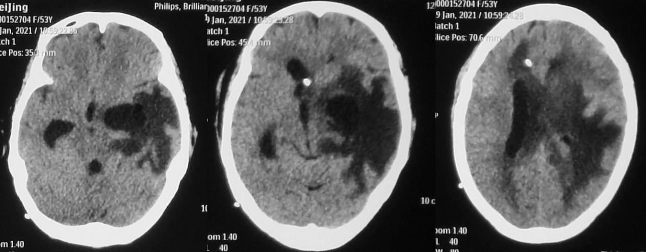 脑脓肿合并脑膜炎需要手术吗,脑脓肿进入左侧脑室严重吗