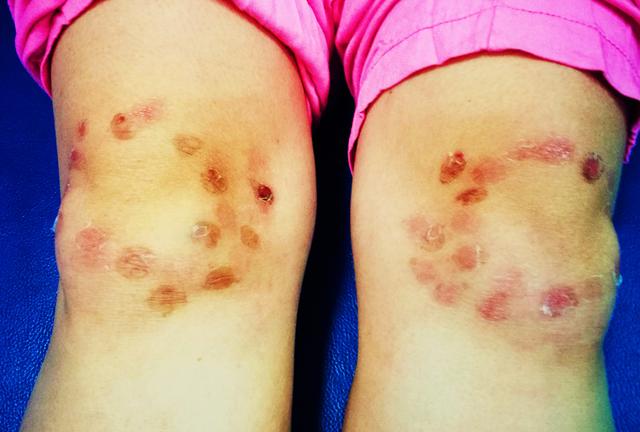 面对多种治疗半月板损伤的办法，我们应该做加法还是做减法？