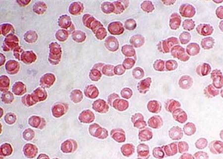 白细胞低医生说要做穿刺来检查,感冒发烧查血常规发现白细胞低