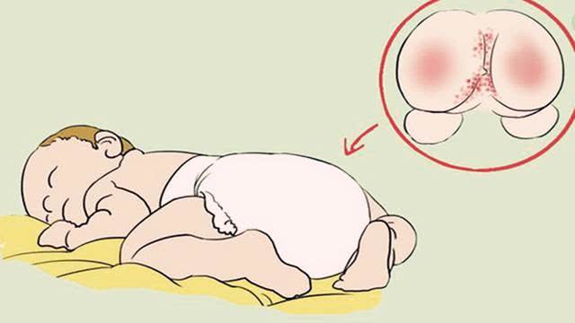 宝宝尿布疹一直反复怎么办,宝宝长尿布疹反反复复怎么办