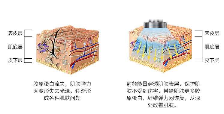 家用射频美容仪有用吗专家讲解,家用射频美容仪有效果吗