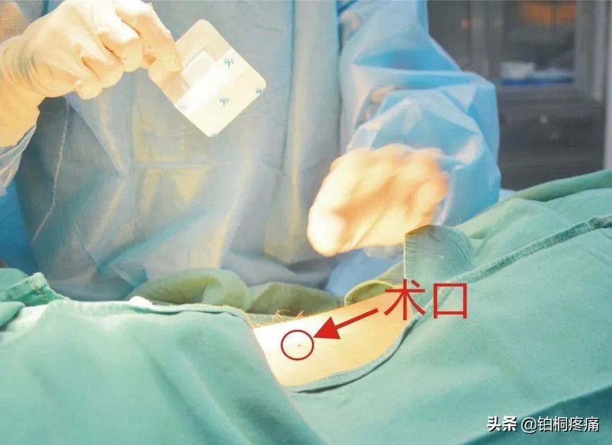 治疗疼痛用的针刀有哪些种,疼痛科小针刀治疗有副作用吗