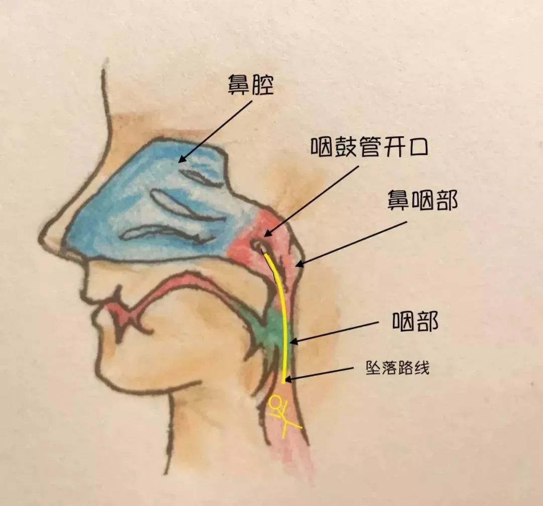 分泌性中耳炎原来是鼻子惹的祸,分泌性中耳炎是治鼻子还是耳朵