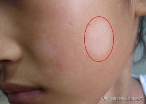 孩子脸上出现虫斑吃什么药,小孩脸上白色斑点和白癜风的区别