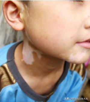 小孩得了白癜风会影响学习吗,孩子得了白癜风压力大