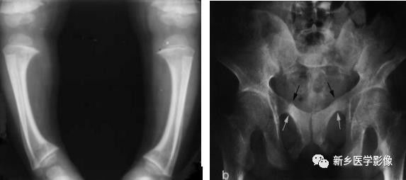 骨骼坏死最佳治疗方法,骨骼疾病治疗