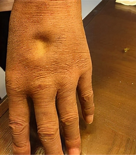 50多岁水肿是什么原因引起的,突然发胖水肿厉害什么原因