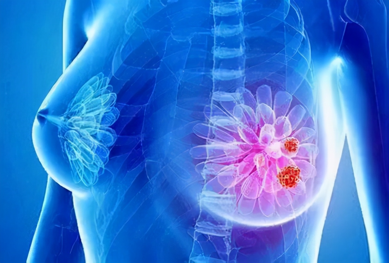 女性12个症状要警惕乳腺癌,女性癌症头号杀手的特点