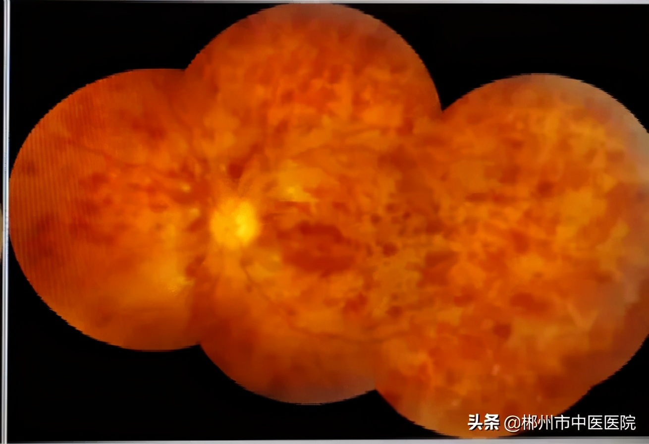 防止视网膜病变的最好方法,视网膜动脉阻塞视力缺损