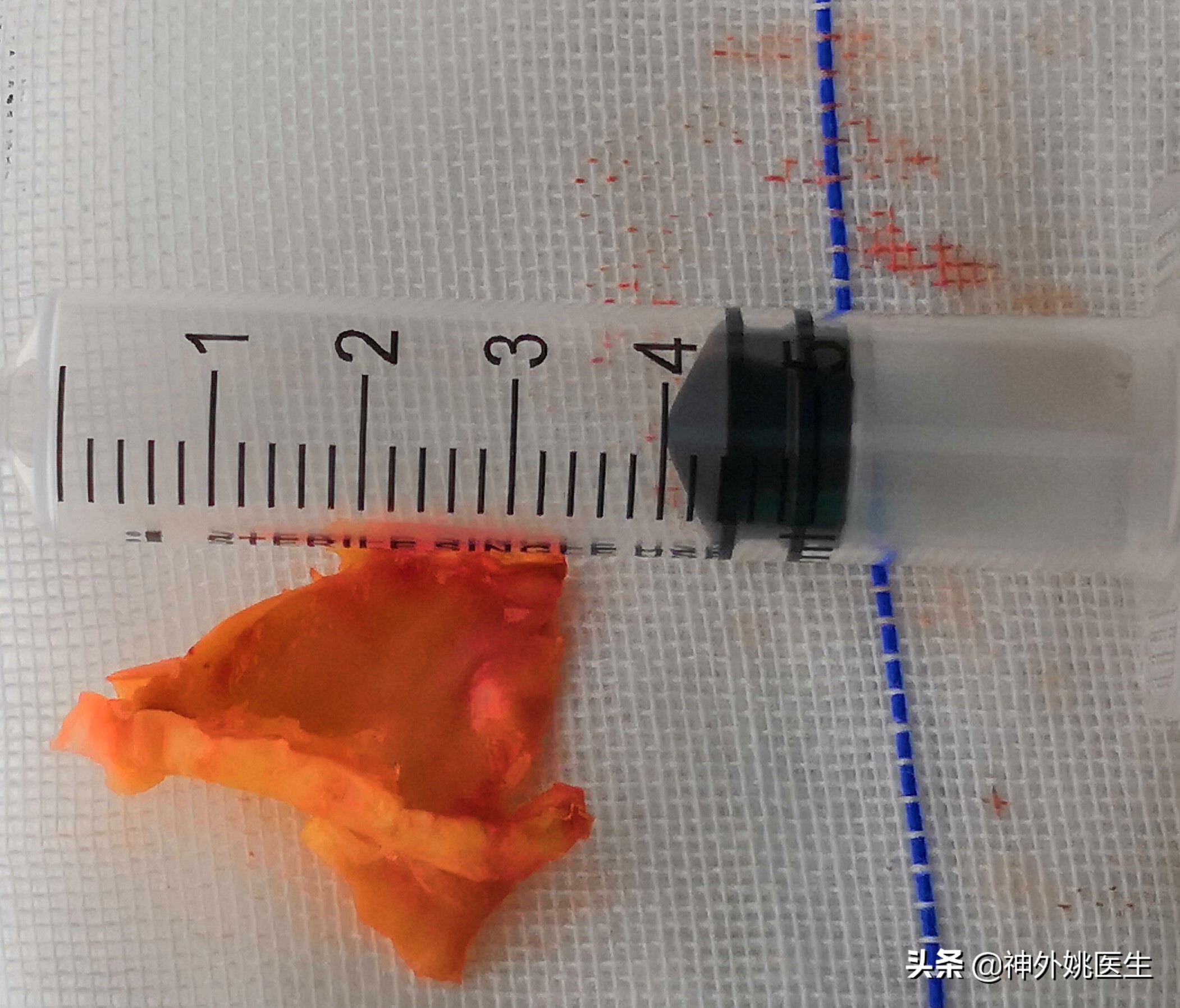颈内动脉狭窄内膜剥脱术风险大吗,颈动脉内膜摘除手术