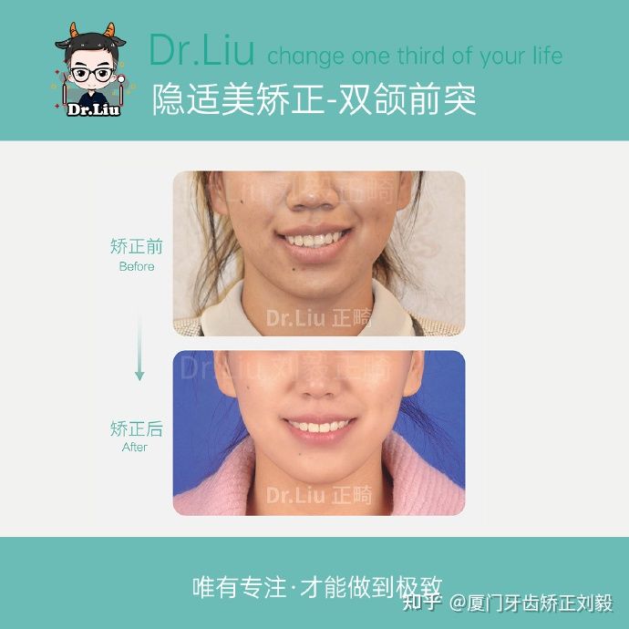 厦门成年人牙齿舌侧矫正,下嘴唇厚且外翻牙齿矫正