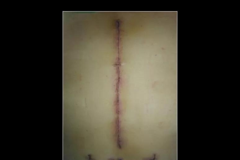 手术后四个月了伤口还是很红,手术后一个月还有线头正常吗