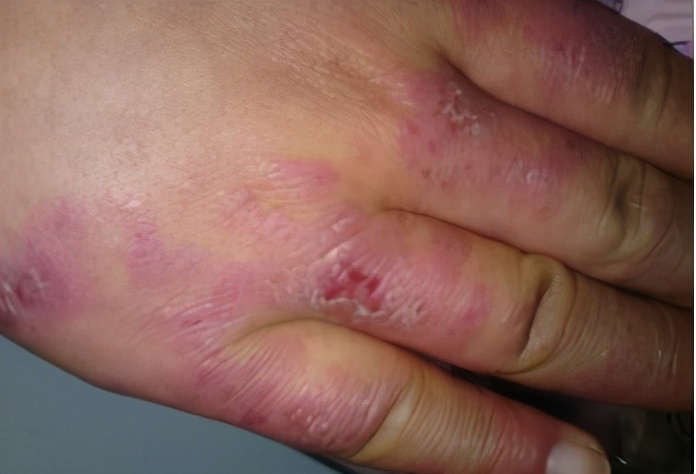 冻疮引起的白癜风会扩散吗,白癜风导致冻疮怎么治