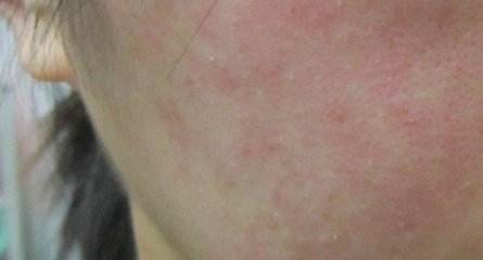 换季皮肤起皮泛红用什么药膏,换季过敏脸干起皮怎么办