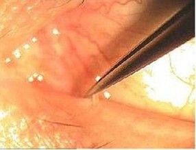 眼睛干涩怎么办,眼睛干涩怎么办别再乱用眼药水了