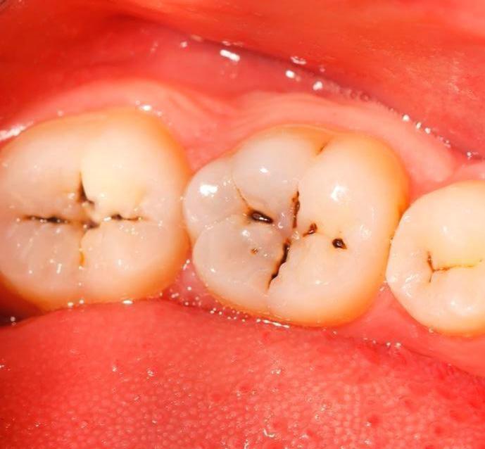 后槽牙有黑线怎么去除,牙沟上有黑线怎么办用什么刷