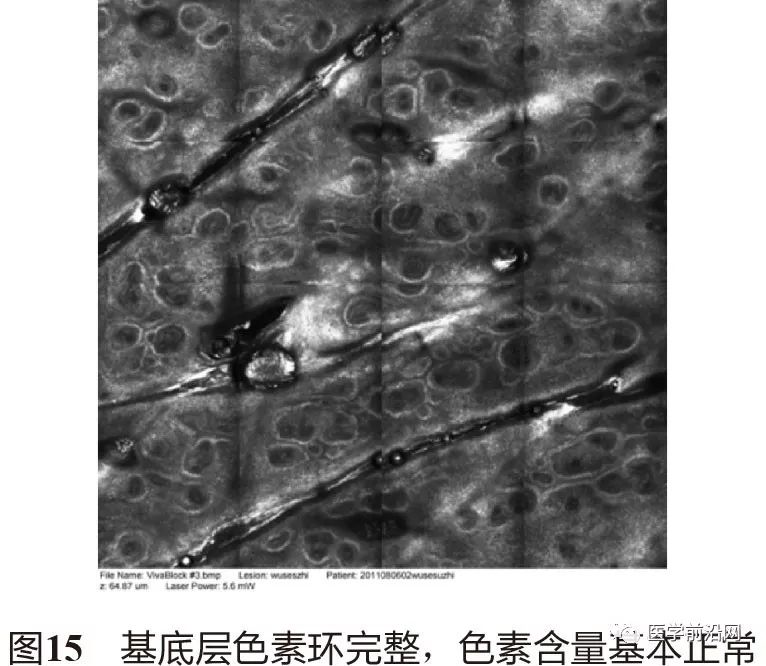 皮肤共聚焦显微镜能查什么,皮肤镜和共聚焦显微镜