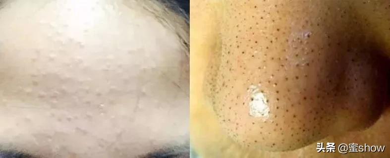 皮肤痘怎么消除,解决皮肤问题对策