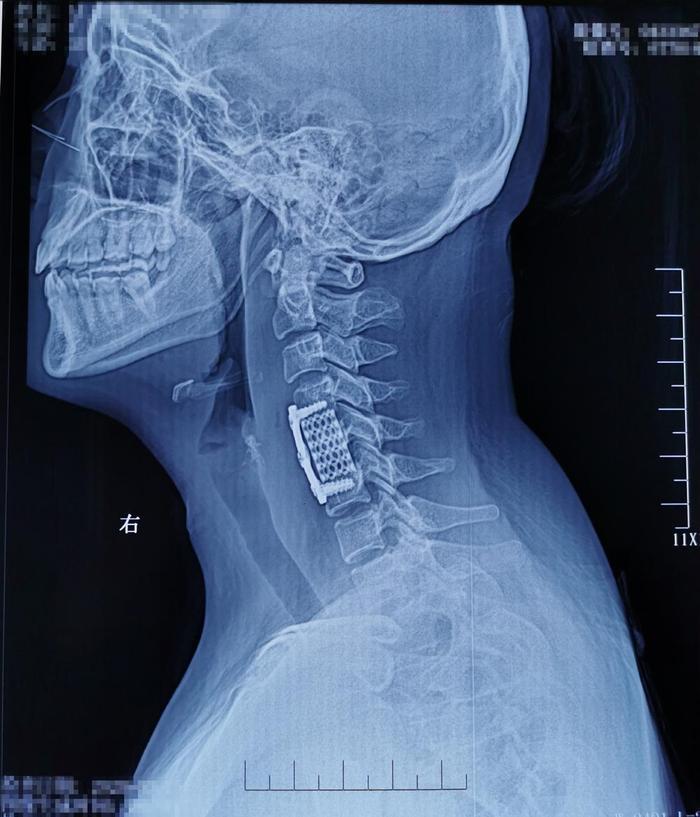 因颈背部疼痛、上臂抽疼，检查出颈5椎体结核