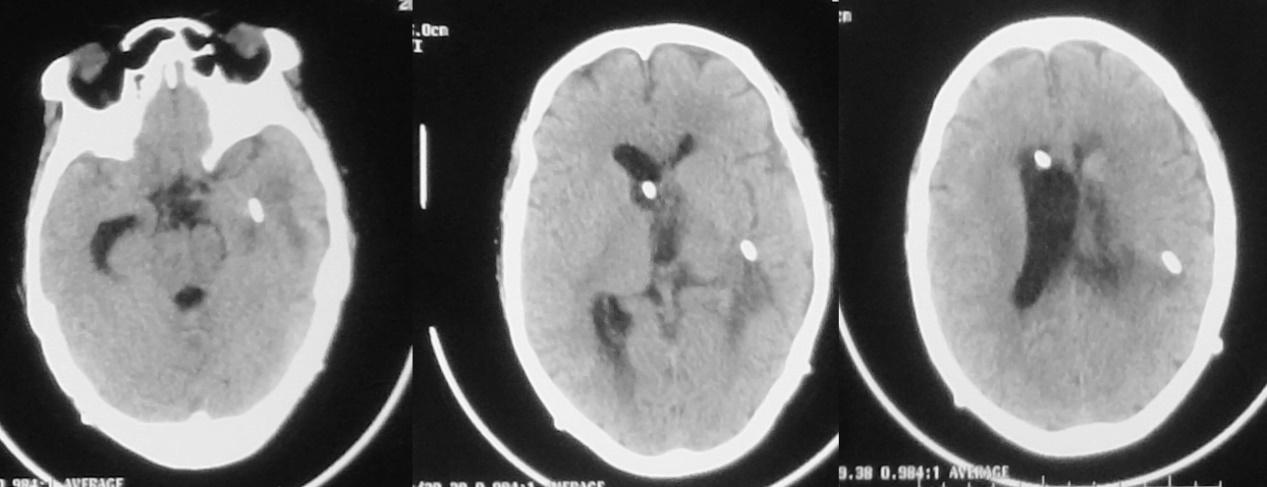 脑脓肿合并脑膜炎需要手术吗,脑脓肿进入左侧脑室严重吗
