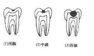牙疼引起神经疼怎么治疗,牙疼引起牙齿疼痛怎么办