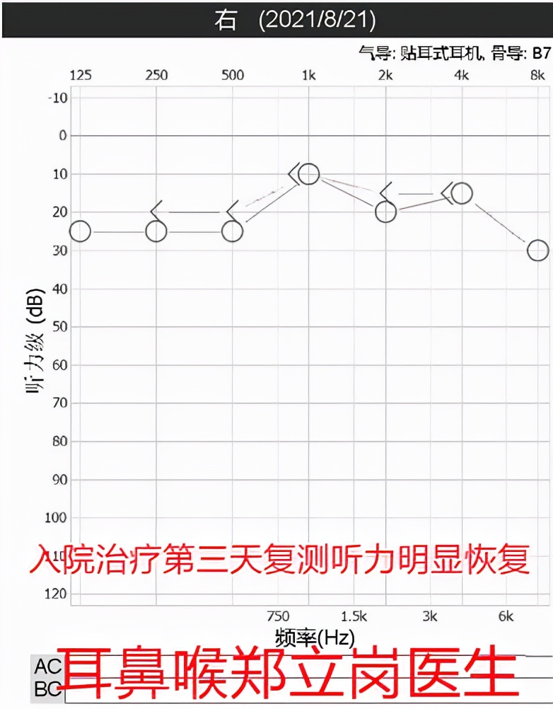 突发性听力下降是什么原因,突发性耳聋针灸后听力下降