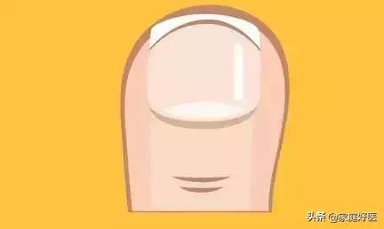 甲沟炎穿什么鞋袜最合适 (甲沟炎恢复了穿凉鞋还会复发吗)