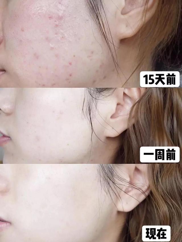 一熬夜就爆痘闭口,一熬夜就长痘痘吃什么药