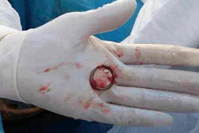 给女性上环到底正不正确,上环避孕的副作用