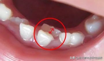 广大口腔公益种牙补贴,领取口腔优惠