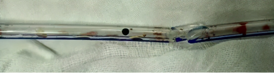 关于放置与拔除引流管那点事,你掌握了吗?