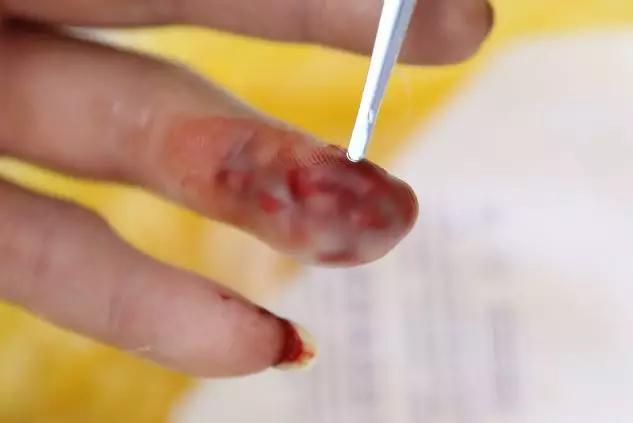 被眼镜蛇咬伤自救,广西桂林被眼镜蛇咬死