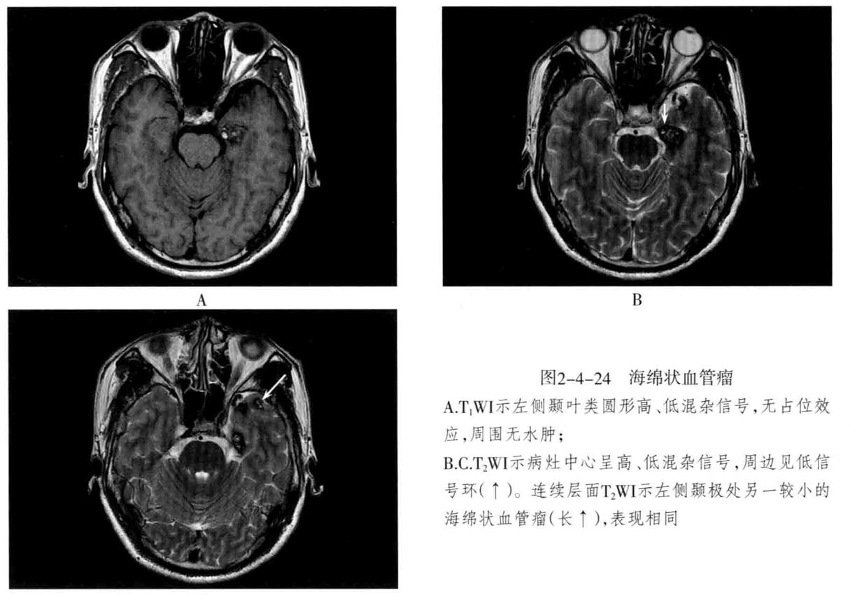 颅内血管轻度狭窄诊断标准,颅内血管先天变异影像