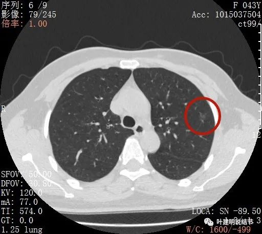 怎样从病理报告看是不是原位癌,原位腺癌切除子宫要开刀吗