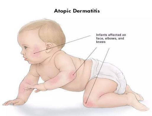 婴儿干性湿疹抹护肤品没有激素,宝宝湿疹要选抗过敏保湿护肤品