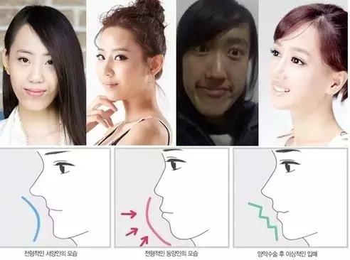 孩子地包天怎么治疗最有效,小孩地包天最佳治疗方法