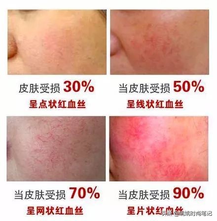 硫磺皂真的可以祛痘吗,硫磺皂真的能祛痘除螨吗