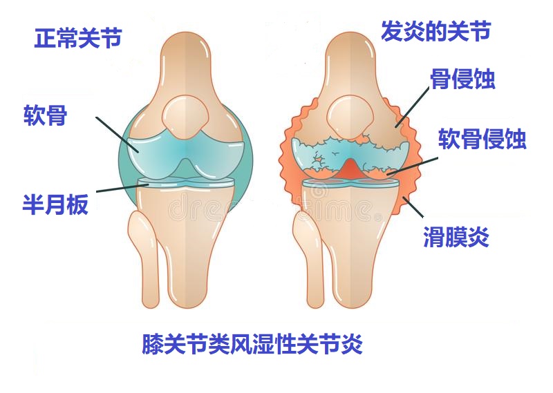 膝盖滑膜炎怎么回事,滑膜炎三大症状