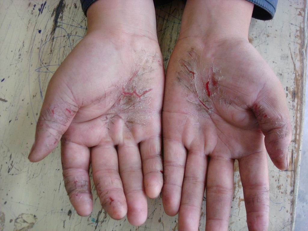 手足癣干裂脱皮怎么治,湿疹和手足癣如何一起治疗