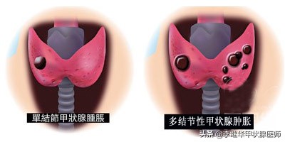 砂粒样钙化是什么意思,钙化结节和肿瘤结节区别