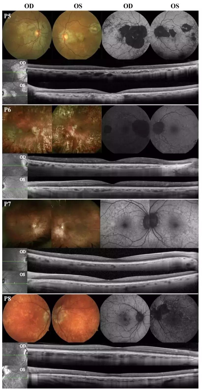 无脉络膜患者,无脉络膜症是怎样致盲