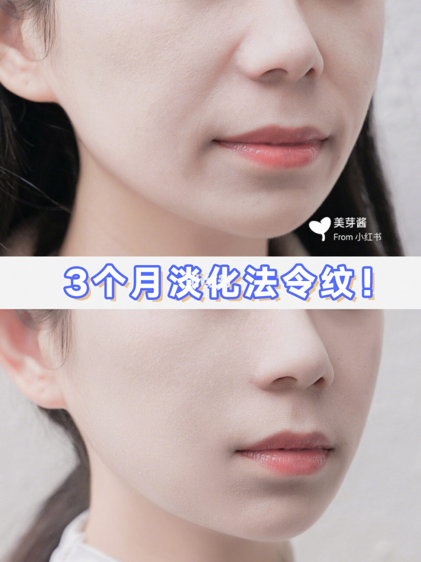 教你一招如何快速淡化法令纹,45岁去法令纹什么方法最适合