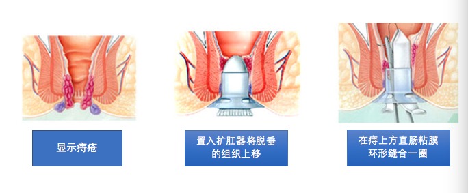 痔疮手术pph微创术多少钱,最安全的痔疮手术是哪种