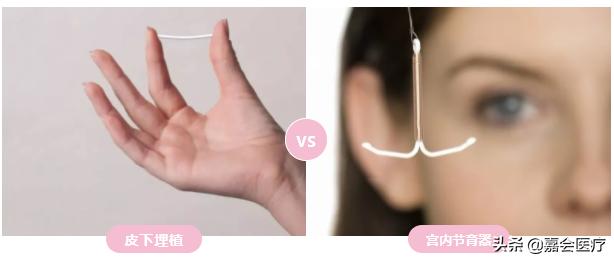 皮埋避孕可以不做避孕措施吗,想长期避孕但不结扎的办法有什么