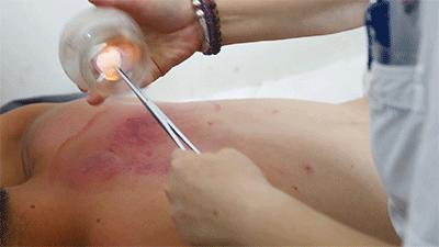 一看就会手把手教拔罐疗法,学拔罐视频教程全集