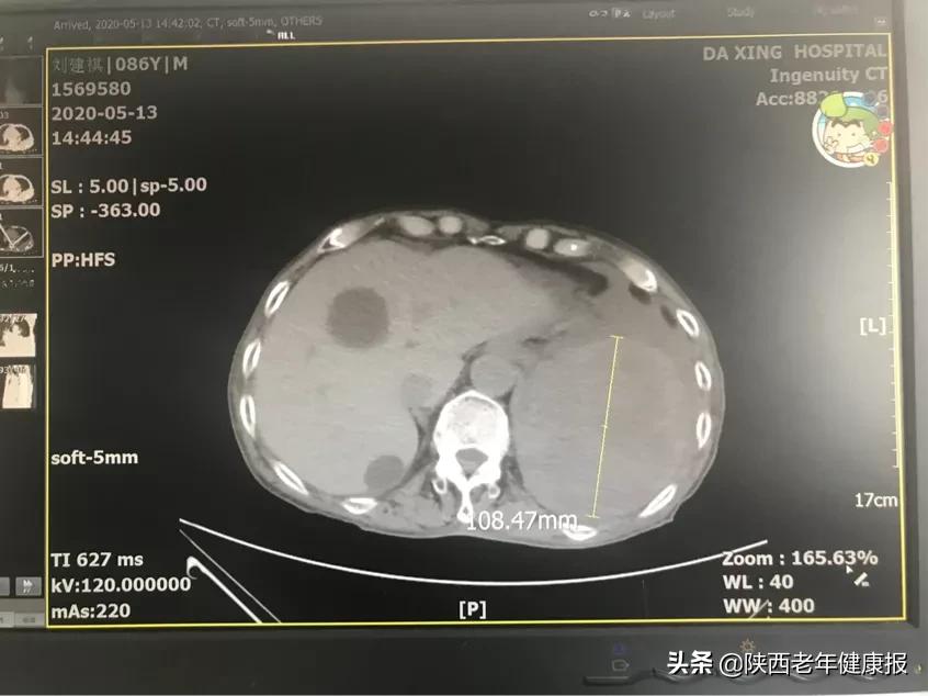胸腔多出一个“心脏”,大兴多学科联合为高龄老人“摘心”祛疾